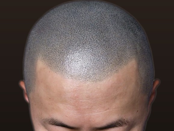 푸르게 변색된 두피 문신